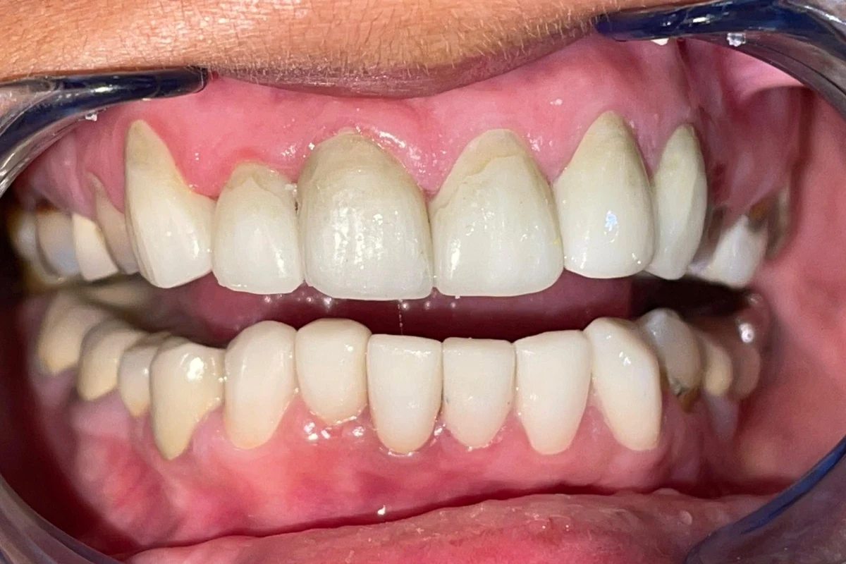 Teeth after multiple-cavity rehabilitation