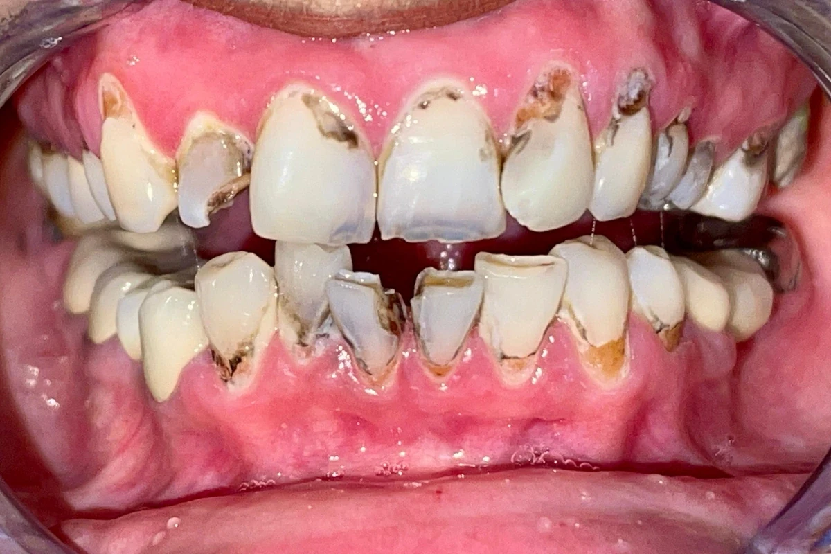 Multiple cavities before rehabilitation