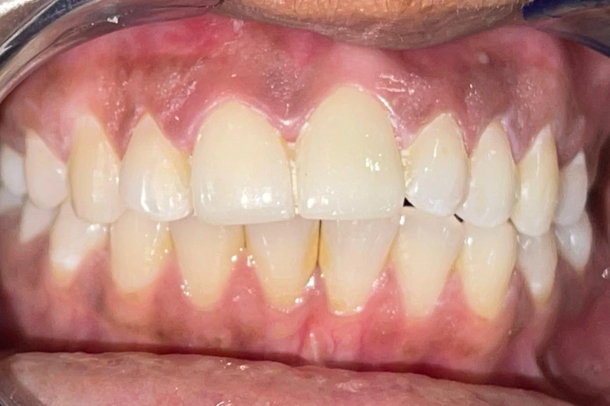 Front tooth after ceramic crown restoration