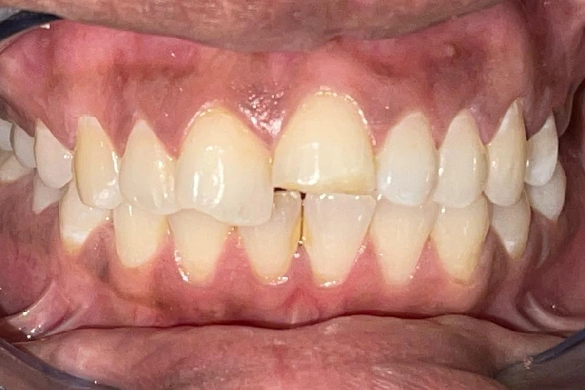 Broken front tooth before ceramic crown treatment