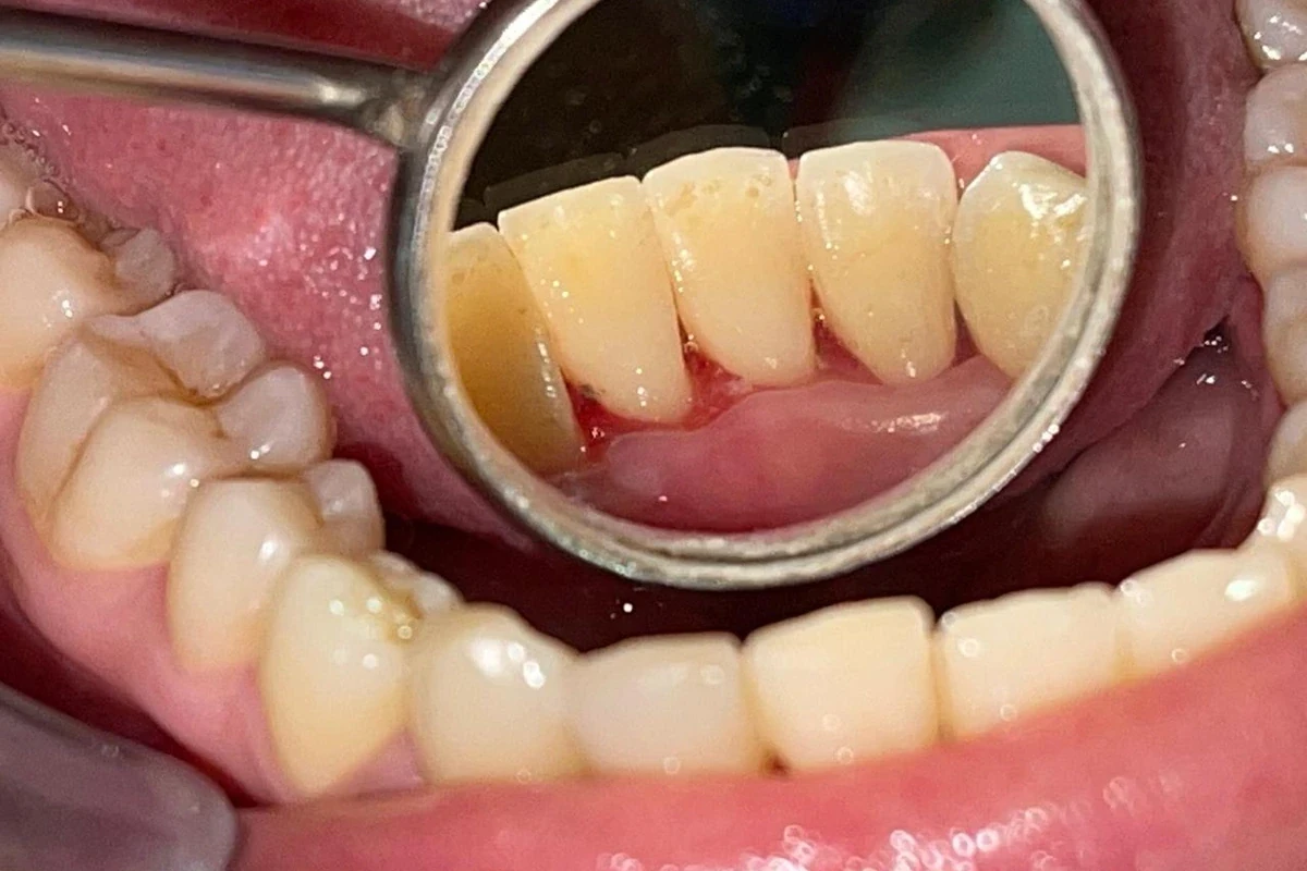 Lower front teeth after professional cleaning
