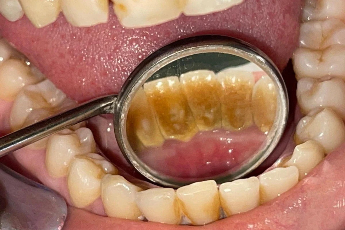 Heavy buildup behind lower front teeth before cleaning