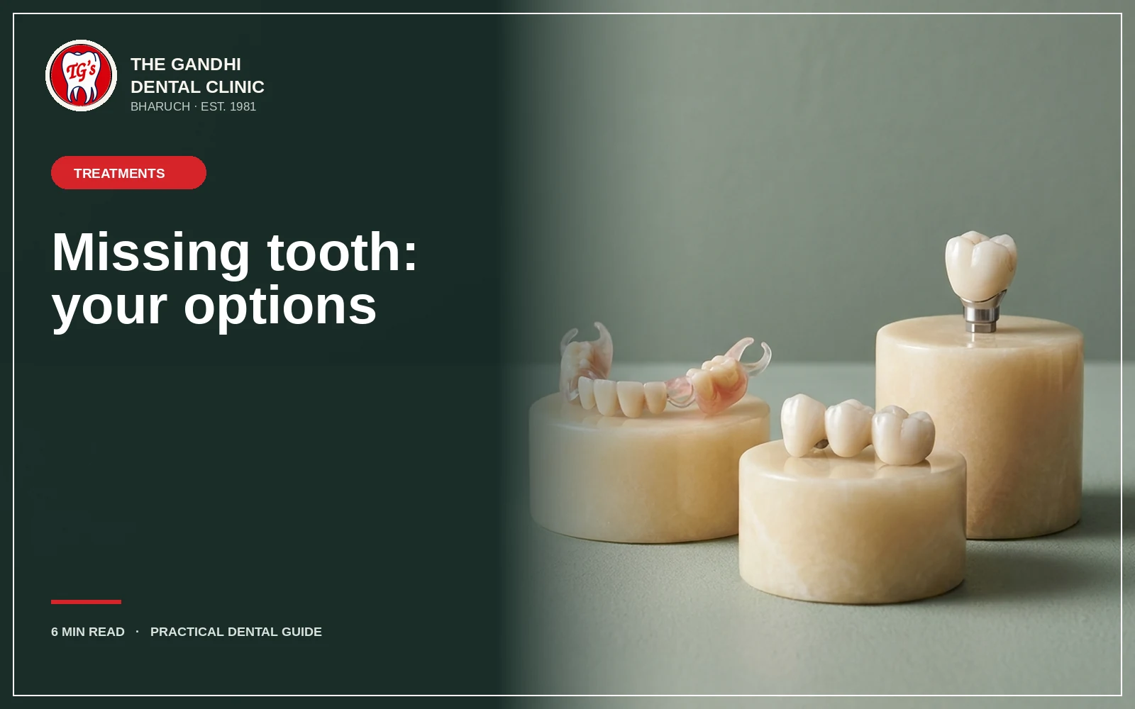 A missing tooth: implant, bridge, denture — or nothing?