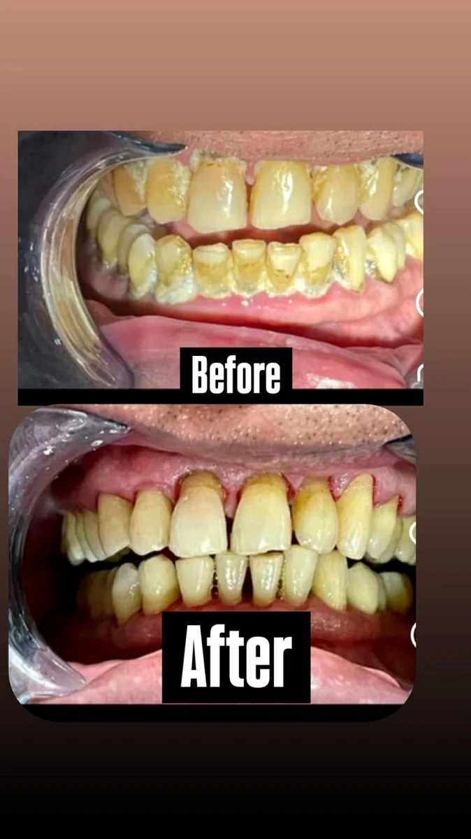 Patient before and after smile result