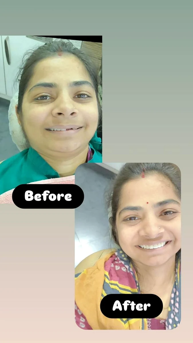 Patient before and after smile result