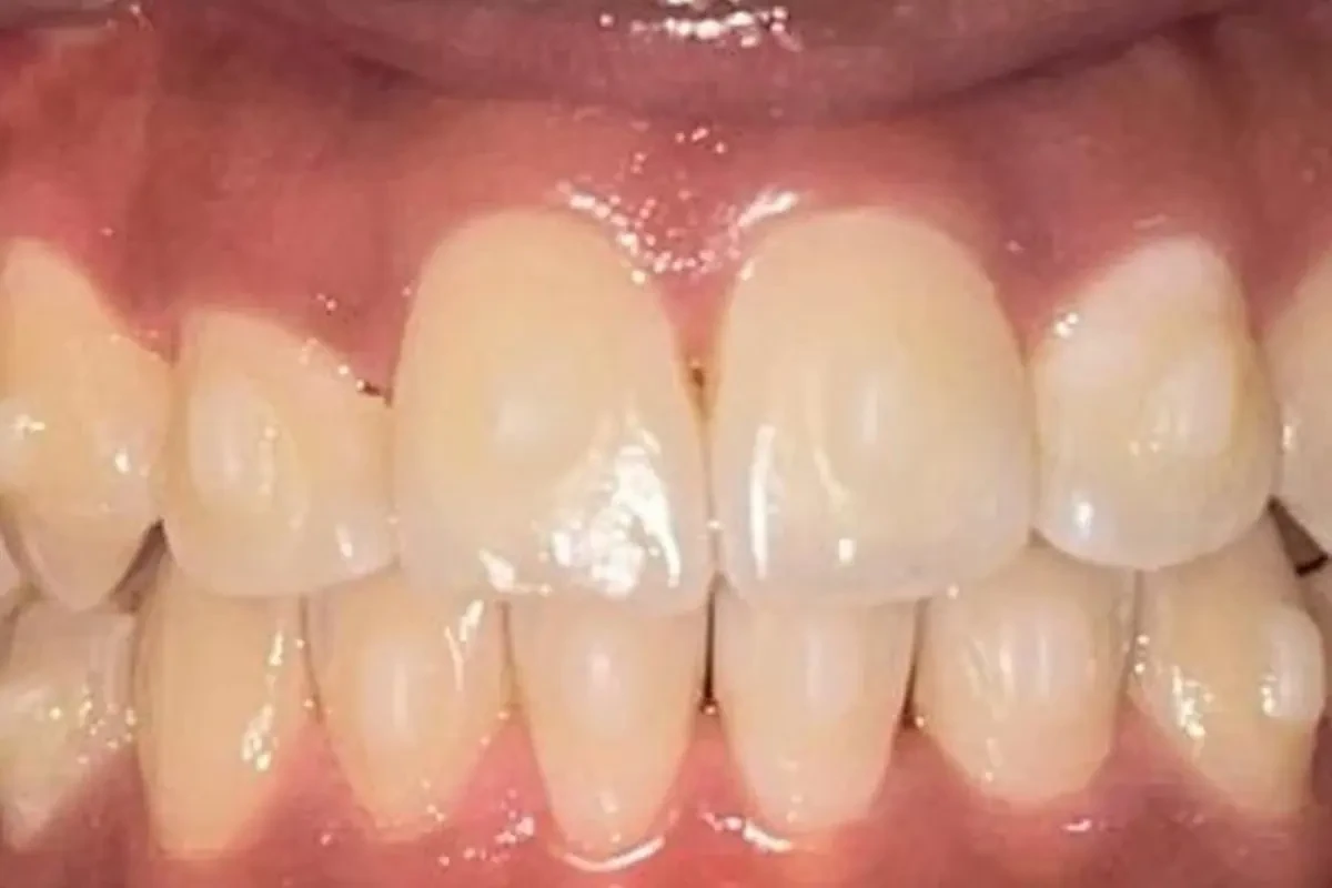 Upper front teeth after clear aligner treatment
