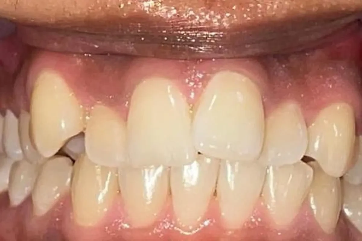 Upper front teeth before clear aligner treatment