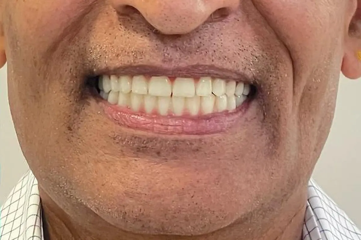 Full mouth after rehabilitation