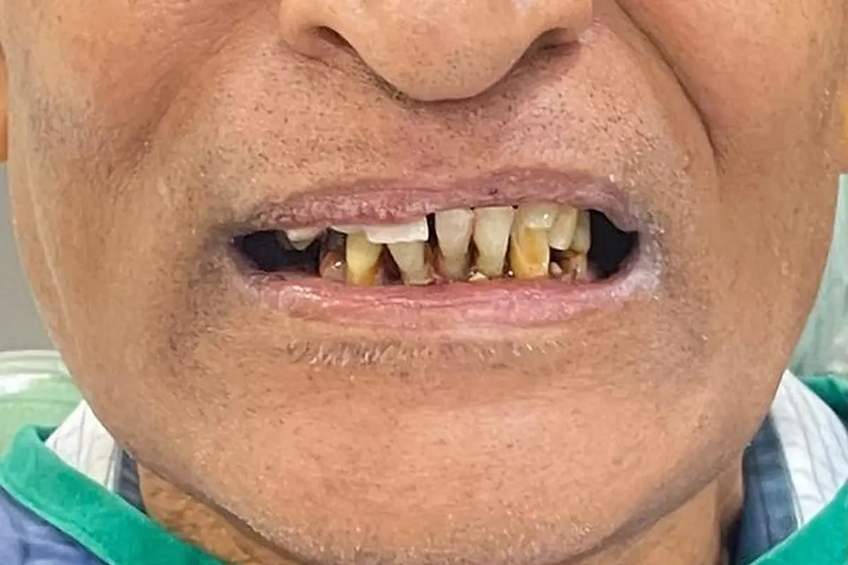 Full mouth before rehabilitation