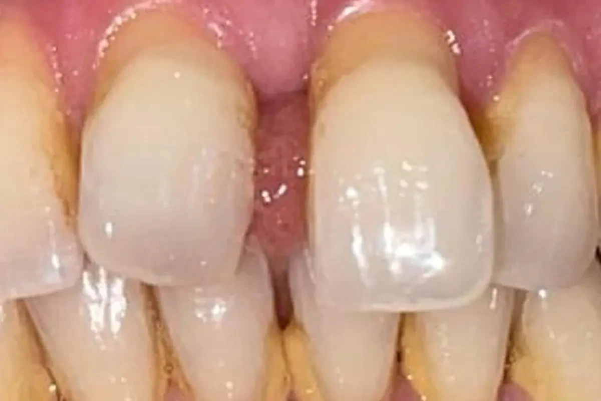 Case 04 — after treatment