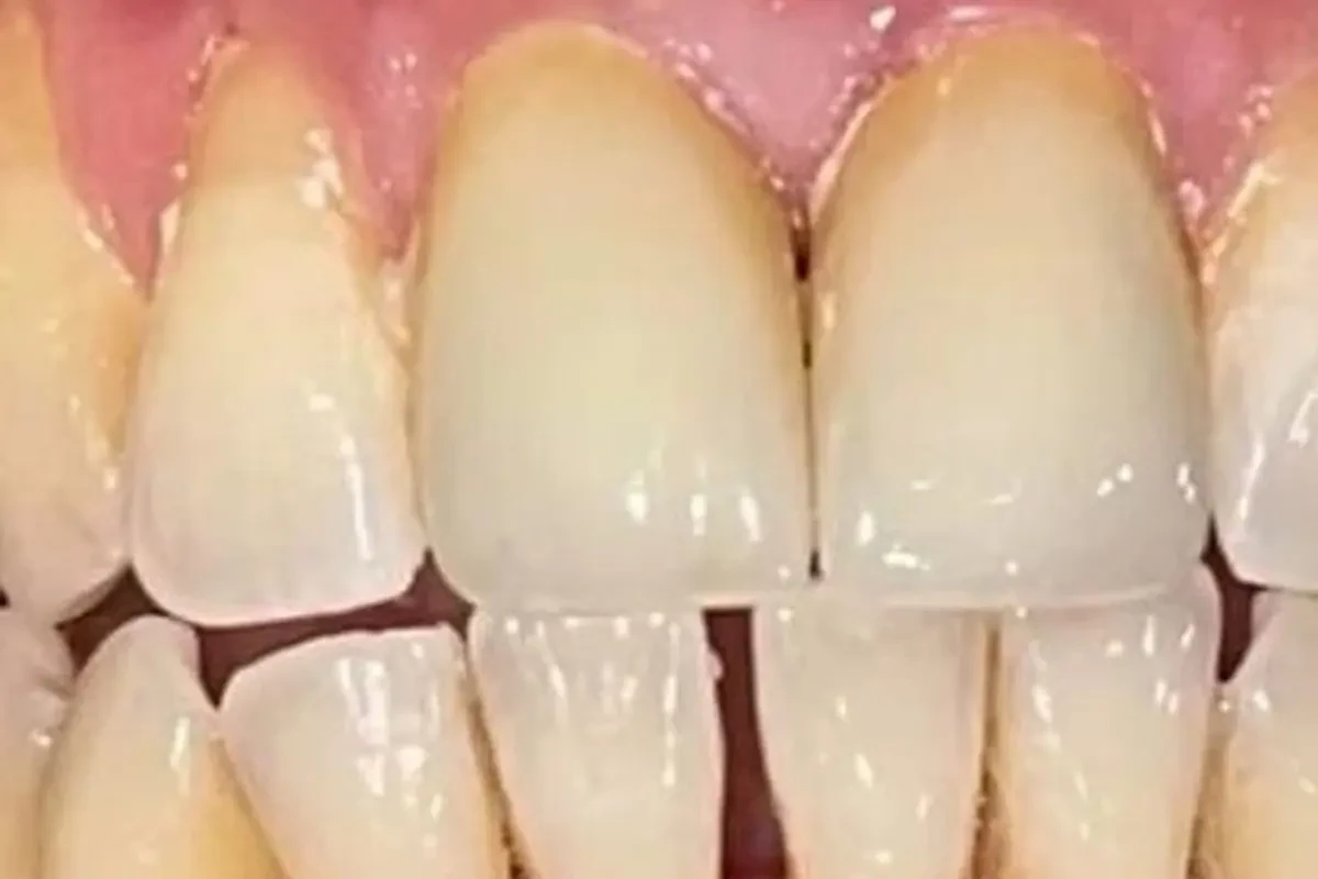 Case 04 — before treatment