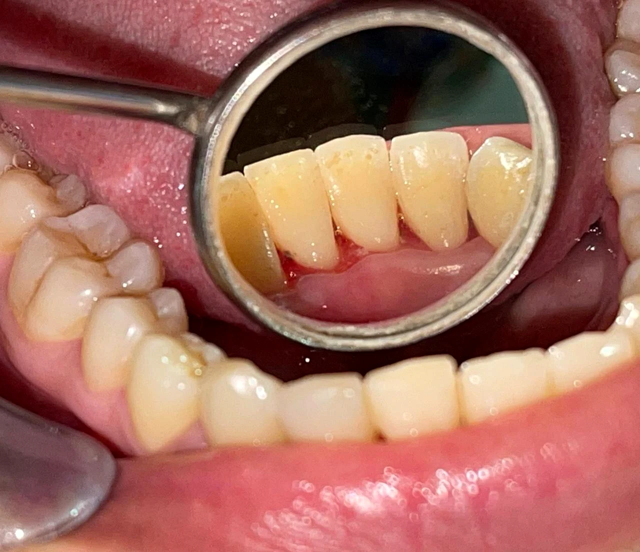 Close-up clinical view of the front teeth