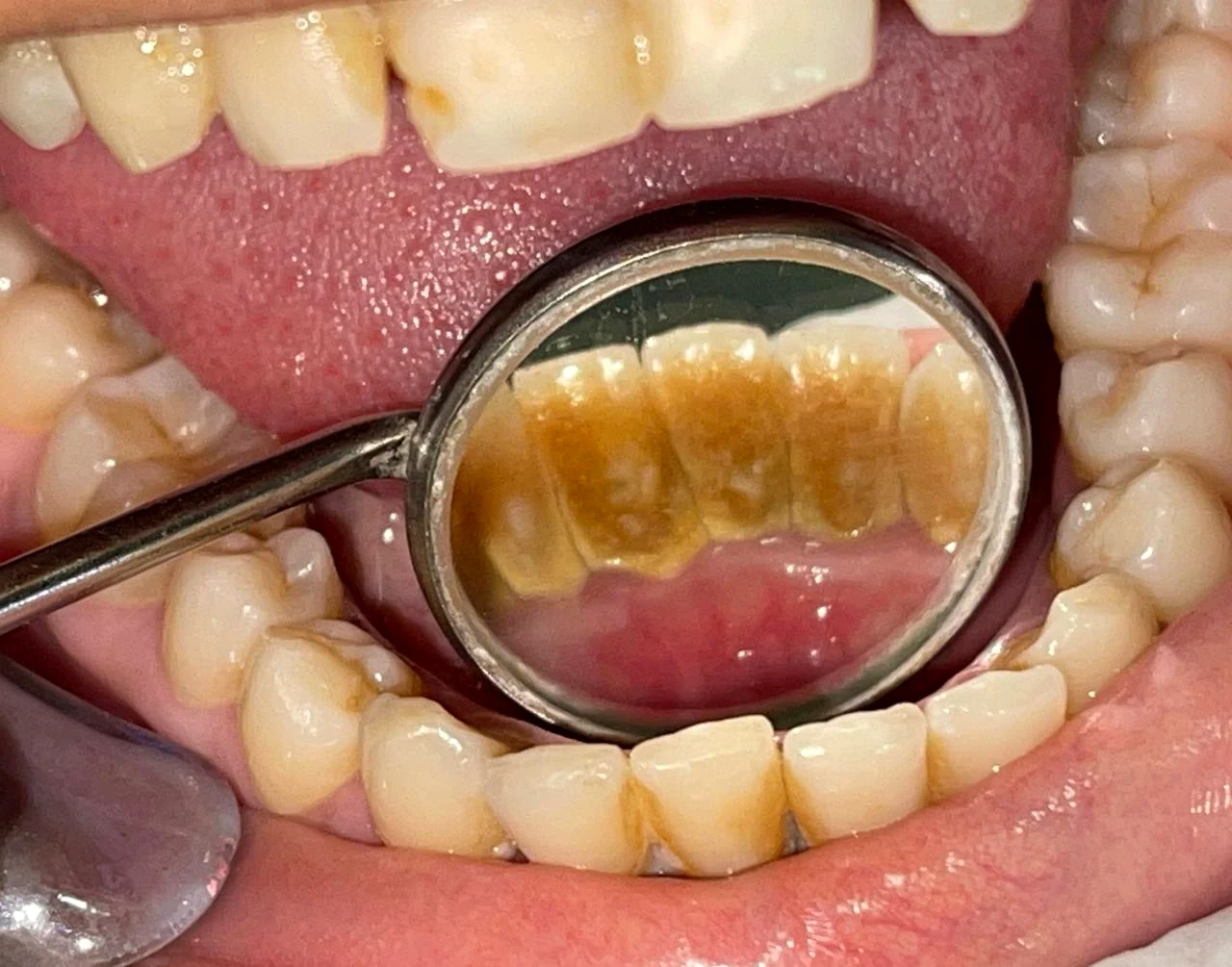 Close-up clinical view of the lower teeth