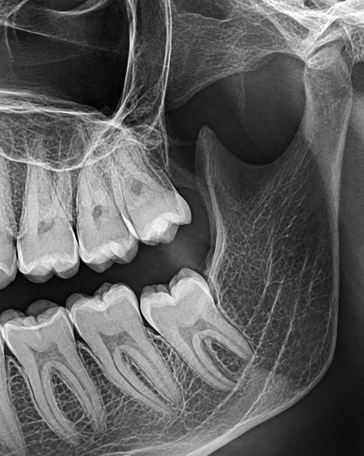 Wisdom tooth removal at Gandhi Dental Clinic, Bharuch